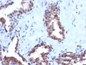 IHC testing of FFPE human prostate carcinoma with Cyclin B1 antibody (clone BCLB1-1).