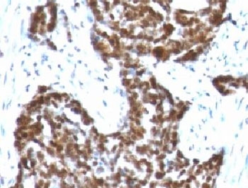 IHC testing of FFPE human ovarian carcinoma with Cyclin B1 antibody (clone BCLB1-1).~