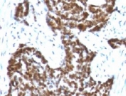IHC testing of FFPE human ovarian carcinoma with Cyclin B1 antibody (clone BCLB1-1).