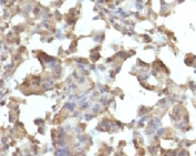 IHC testing of FFPE human histiocytoma and TNF alpha antibody (clone TMDa1-1). Staining of formalin-fixed tissues requires boiling tissue sections in 10mM Tris buffer with 1mM EDTA, pH 9, for 10-20 min followed by cooling at RT for 20 min.