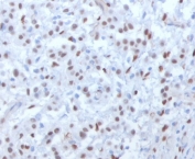 IHC testing of FFPE human mesothelioma with WT1 antibody (clone WLMT1-1). Required HIER: boil tissue sections in pH 9 10mM Tris with 1mM EDTA for 10-20 min followed by cooling at RT for 20 min.