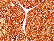 IHC testing of FFPE human melanoma with Tyrosinase antibody (clone TRSN1-1). Staining of formalin-fixed tissues requires boiling tissue sections in 10mM Tris with 1mM EDTA, pH 9 for 10-20 min followed by cooling at RT for 20 min.
