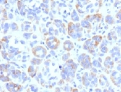 IHC testing of FFPE human melanoma with TRP1 antibody (clone TYRR1-1). Required HIER: boil tissue sections in 10mM Tris with 1mM EDTA, pH 9, for 10-20 min followed by cooling at RT for 20 min.