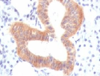 IHC testing of FFPE human melanoma with CD86 antibody (clone CDLA86). Staining of formalin-fixed tissues requires boiling tissue sections in 10mM Tris buffer with 1mM EDTA, pH 9, for 10-20 min followed by cooling at RT for 20 min.~