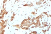 IHC testing of FFPE human breast carcinoma with GRP94 antibody (clone SRPR90b). FFPE testing requires sections to be boiled in pH 9 10mM Tris with 1mM EDTA for 10-20 minutes, followed by cooling at RT for 20 minutes, prior to staining.