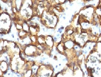 IHC testing of FFPE human angiosarcoma with CD34 antibody (clone CDLA34-1).~