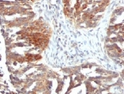 IHC testing of FFPE human ovarian carcinoma with VEGF antibody (clone VGFA-1).