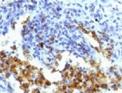 IHC testing of FFPE human lung adenocarcinoma with Napsin A antibody (clone NPSNA-1). FFPE testing requires sections to be boiled in pH 9 10mM Tris with 1mM EDTA for 10-20 minutes, followed by cooling at RT for 20 minutes, prior to staining.