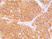 IHC testing of FFPE human renal cell carcinoma with CAIX antibody (clone CBAD9-1).