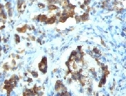 IHC testing of FFPE human gastric carcinoma with Cdc20 antibody (clone CLDC20-1). FFPE testing requires sections to be boiled in pH 9 10mM Tris with 1mM EDTA for 10-20 minutes, followed by cooling at RT for 20 minutes, prior to staining.