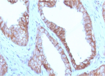 IHC staining of FFPE human prostate carcinoma with CD47 antibody (clone CDLA47-1). HIER: boil tissue sections in pH6, 10mM citrate buffer, for 10-20 min and allow to cool before testing.~