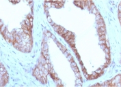 IHC staining of FFPE human prostate carcinoma with CD47 antibody (clone CDLA47-1). HIER: boil tissue sections in pH6, 10mM citrate buffer, for 10-20 min and allow to cool before testing.