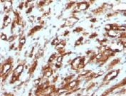 IHC testing of FFPE human rhabdomyosarcoma with Muscle Actin antibody (clone PMAC1-1). FFPE testing requires sections to be boiled in pH 9 10mM Tris with 1mM EDTA for 10-20 minutes, followed by cooling at RT for 20 minutes, prior to staining.