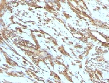 IHC testing of FFPE human leiomyosarcoma with Muscle Actin antibody. FFPE testing requires sections to be boiled in pH 9 10mM Tris with 1mM EDTA for 10-20 minutes, followed by cooling at RT for 20 minutes, prior to staining.