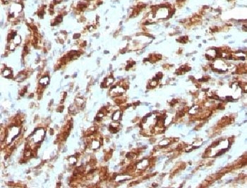 IHC testing of FFPE human rhabdomyosarcoma with Muscle Actin antibody. FFPE testing requires sections to be boiled in pH 9 10mM Tris with 1mM EDTA for 10-20 minutes, followed by cooling at RT for 20 minutes, prior to staining.