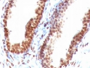 IHC testing of FFPE human colon carcinoma with dsDNA antibody (clone DRNC1-1). FFPE testing requires sections to be boiled in pH 9 10mM Tris with 1mM EDTA for 10-20 minutes, followed by cooling at RT for 20 minutes, prior to staining.