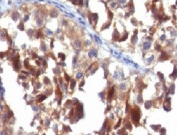 IHC testing of FFPE human melanoma with CD63 antibody (clone CDLA63-1). HIER: FFPE testing requires sections to be boiled in pH6 10mM citrate buffer for 10-20 minutes, followed by cooling at RT for 20 minutes, prior to staining.
