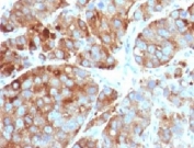 IHC testing of FFPE human prostate carcinoma with CD63 antibody (clone CDLA63-1). HIER: FFPE testing requires sections to be boiled in pH6 10mM citrate buffer for 10-20 minutes, followed by cooling at RT for 20 minutes, prior to staining.