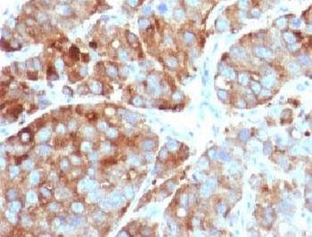 IHC testing of FFPE human prostate carcinoma with CD63 antibody (clone CDLA63-1). HIER: FFPE testing requires sections to be boiled in pH6 10mM citrate buffer for 10-20 minutes, followed by cooling at RT for 20 minutes, prior to staining.~