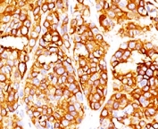 IHC testing of formalin-fixed, paraffin-embedded human melanoma stained with recombinant MART-1 antibody (clone RMMRT1-1). HIER: steam sections in pH 9 10mM Tris with 1mM EDTA for 10-20 min.