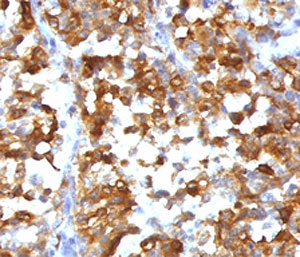 IHC testing of formalin-fixed, paraffin-embedded human melanoma stained with recombinant MART-1 antibody (clone RMMRT1-1). HIER: steam sections in pH 9 10mM Tris with 1mM EDTA for 10-20 min.~