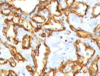 IHC staining of FFPE human angiocarcinoma with recombinant CD31 antibody (clone RMCD31-1). HIER: steam sections in 1mM EDTA, pH 9, for 10-20 min.