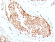 IHC testing of FFPE human testicular carcinoma with ALDH1 antibody (clone AHDH1-1).