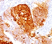 IHC testing of FFPE human colon carcinoma with ALDH1 antibody (clone AHDH1-1).