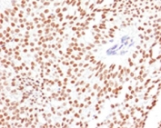 IHC testing of FFPE human bladder carcinoma with FOXA1 antibody (clone FHBA1-1). Staining of FFPE tissue is enhanced by boiling sections in 10mM Tris with 1mM EDTA, pH9 for 10-20 min followed by cooling at RT for 20 min.