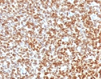 IHC testing of FFPE Ewings sarcoma with recombinant NKX2.2 antibody (clone RMNK2-1)