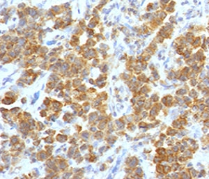 IHC testing of FFPE human parathyroid tumor with TL1A antibody (clone TLRM1-1). Staining of FFPE tissue requires boiling sections in 10mM Tris with 1mM EDTA, pH9, for 10-20 min followed by cooling at RT for 20 min.~
