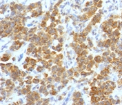 IHC testing of FFPE human parathyroid tumor with TL1A antibody (clone TLRM1-1). Staining of FFPE tissue requires boiling sections in 10mM Tris with 1mM EDTA, pH9, for 10-20 min followed by cooling at RT for 20 min.