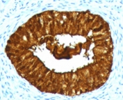 IHC testing of FFPE human cervical carcinoma with MAML3 antibody (clone MMLP3-1).