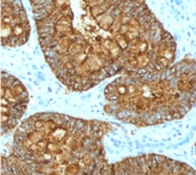 IHC testing of FFPE human colon carcinoma with MAML3 antibody (clone MMLP3-1).