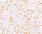 IHC testing of FFPE human bladder carcinoma with Topoisomerase II alpha antibody (clone TPM2A-2).