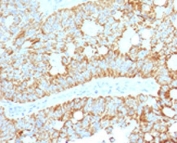 IHC testing of FFPE human colon carcinoma with MAML2 antibody (clone MMLP2-1). Staining of FFPE tissue requires boiling sections in 10mM Tris with 1mM EDTA, pH9, for 10-20 min followed by cooling at RT for 20 min.