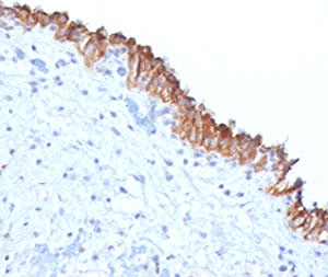 IHC testing of FFPE human bladder carcinoma with MAML2 antibody (clone MMLP2-1). Staining of FFPE tissue requires boiling sections in 10mM Tris with 1mM EDTA, pH9, for 10-20 min followed by cooling at RT for 20 min.~