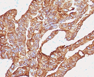 IHC testing of human colorectal carcinoma with anti-EpCAM antibody (clone EPM17-2). Staining of FFPE tissue requires boiling sections in pH 9 10mM Tris with 1mM EDTA for 10-20 min followed by cooling at RT for 20 min.~