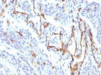 IHC staining of FFPE human angiocarcinoma with recombinant CD31 antibody (clone C31/1395R). Required HIER: boil tissue sections in 10mM Tris with 1mM EDTA, pH9, for 10-20 min followed by cooling at RT for 20 min.~