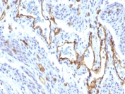 IHC staining of FFPE human angiocarcinoma with recombinant CD31 antibody (clone C31/1395R). Required HIER: boil tissue sections in 10mM Tris with 1mM EDTA, pH9, for 10-20 min followed by cooling at RT for 20 min.