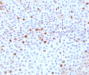 IHC testing of FFPE human bladder carcinoma with TOP2A antibody (clone TPM2A-1).