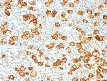 IHC testing of FFPE human Hodgkin's lymphoma stained with recombinant CD30 antibody (clone Ki-1/1505R). Required HIER: steam sections in pH9, 1mM EDTA for 10-20 min.~