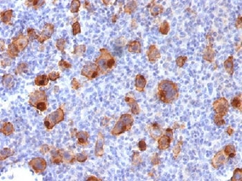 IHC testing of FFPE human Hodgkin's lymphoma stained with recombinant CD30 antibody (clone Ki-1/1747R). Required HIER: steam sections in pH9, 1mM EDTA for 10-20 min.~