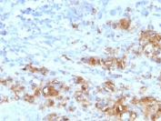 IHC testing of FFPE human gastric carcinoma with recombinant CA19-9 antibody (clone CA19.9/1390R). HIER: steam sections in pH6 citrate buffer for 10-20 min.