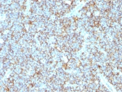 IHC testing of FFPE human Ewing's sarcoma with recombinant CD99 antibody (clone MIC2/1495R). Required HIER: steam sections in 10mM Citrate buffer, pH 6.0, for 10-20 min.