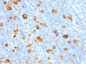 IHC testing of FFPE human Hodgkin's lymphoma and recombinant CD15 antibody (clone FUT4/1478R). Required HIER: steam sections in 10mM Tris with 1mM EDTA, pH 9.0, for 10-20 min.