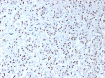 IHC testing of FFPE human mesothelioma tissue with recombinant WT1 antibody (clone WT1/1434R). HIER: steam sections in pH 9 10mM Tris with 1mM EDTA for 10-20 min.~