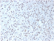 IHC testing of FFPE human mesothelioma tissue with recombinant WT1 antibody (clone WT1/1434R). HIER: steam sections in pH 9 10mM Tris with 1mM EDTA for 10-20 min.