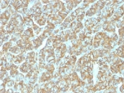 IHC testing of FFPE human thyroid carcinoma and recombinant EpCAM antibody (clone EGP40/1555R). HIER: steam sections in pH6 citrate buffer for 10-20 min.