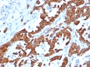 IHC testing of FFPE human prostate carcinoma and recombinant EpCAM antibody (clone EGP40/1555R). HIER: steam sections in pH9 EDTA for 10-20 min.